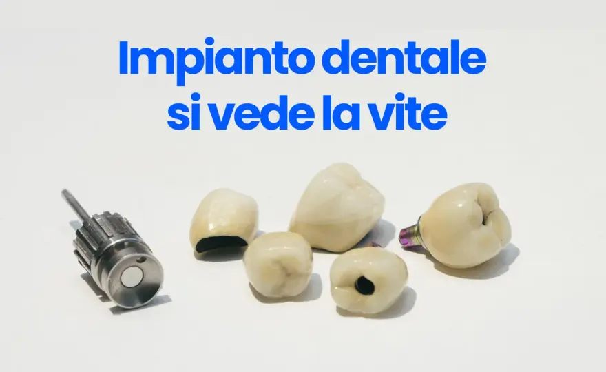 Impianto dentale - Vite visibile: quando preoccuparsi?