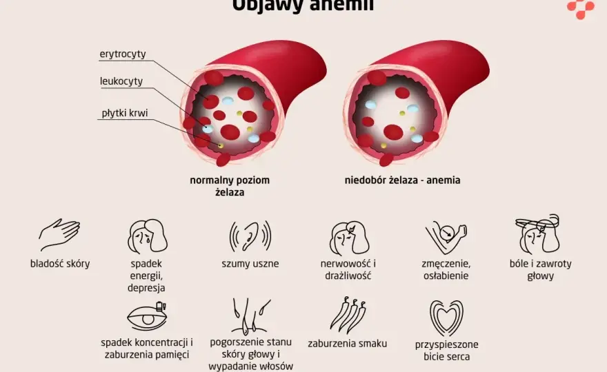 Anemia - kiedy jest groźna? Objawy, diagnostyka, leczenie