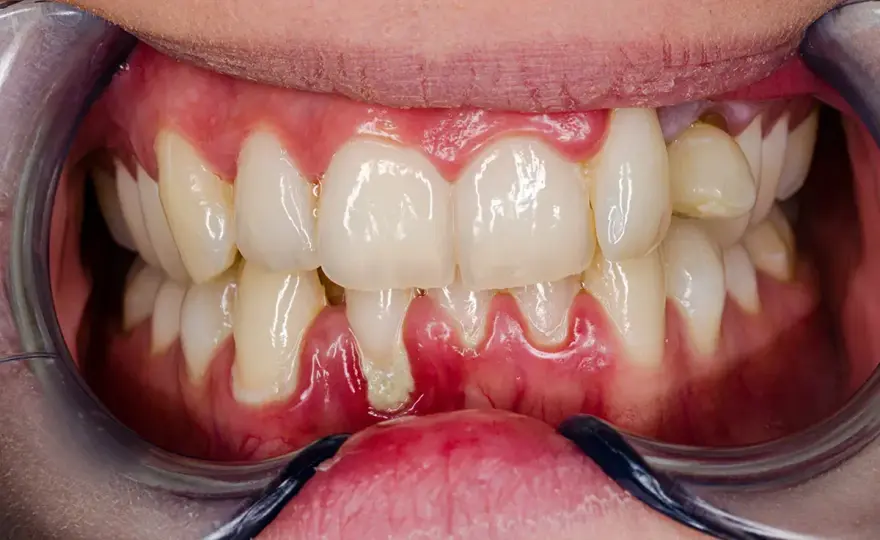 Gengivite acuta, cosa fare e quando andare dal dentista?