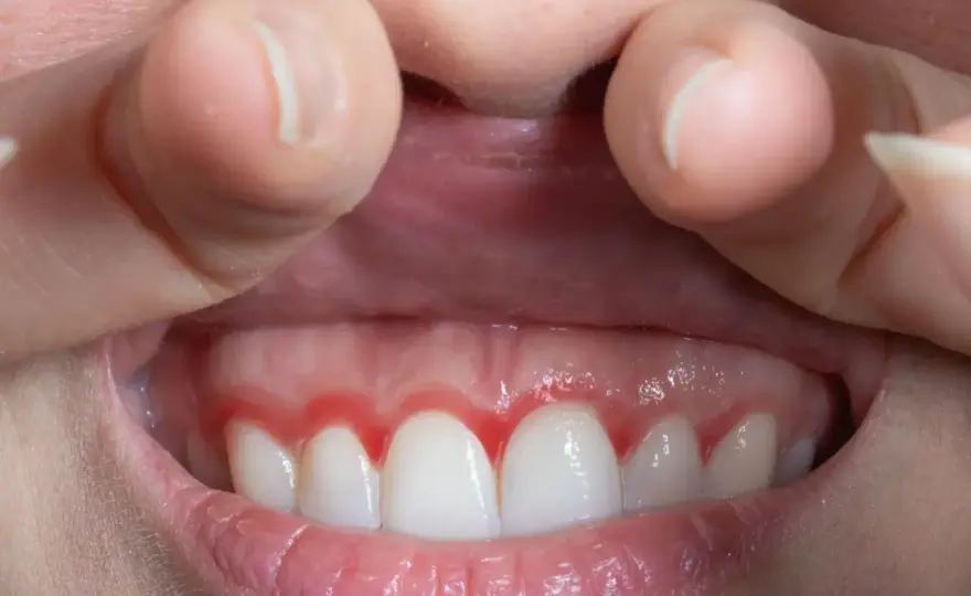 Encías rojas e inflamadas - causas y cuándo ir al dentista