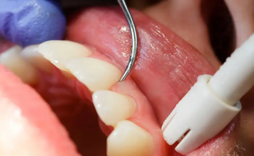Cómo tratar la gingivitis y cuándo acudir al dentista