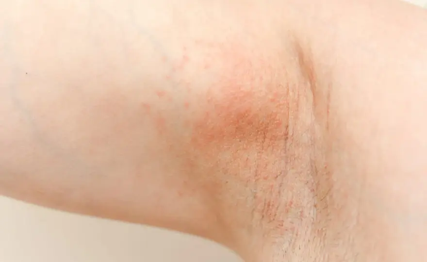 Uczulenie na antyperspirant - jak rozpoznać i co zrobić?