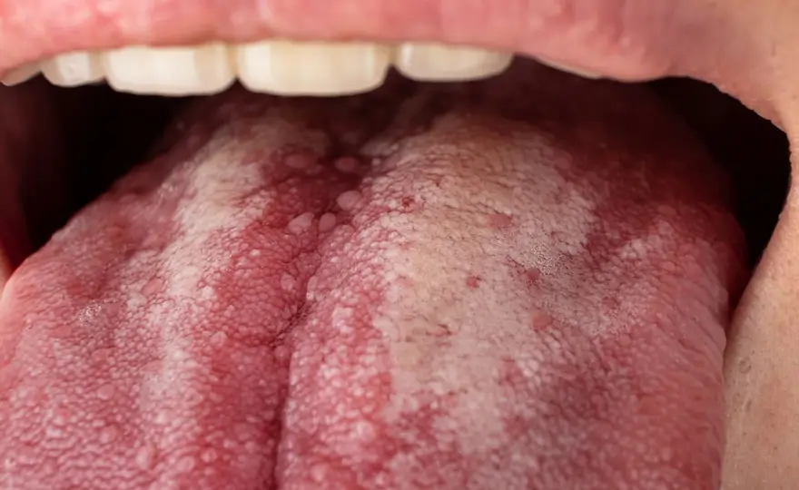 Manchas rojas en la lengua y dolor de garganta ¿cuándo consultar?