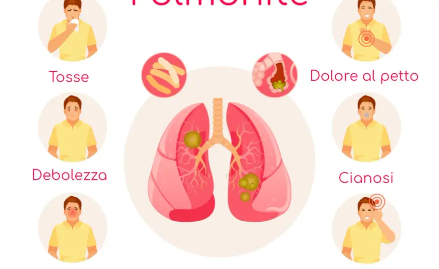 Polmonite ab ingestis nei bambini - sintomi e segnali d’allarme
