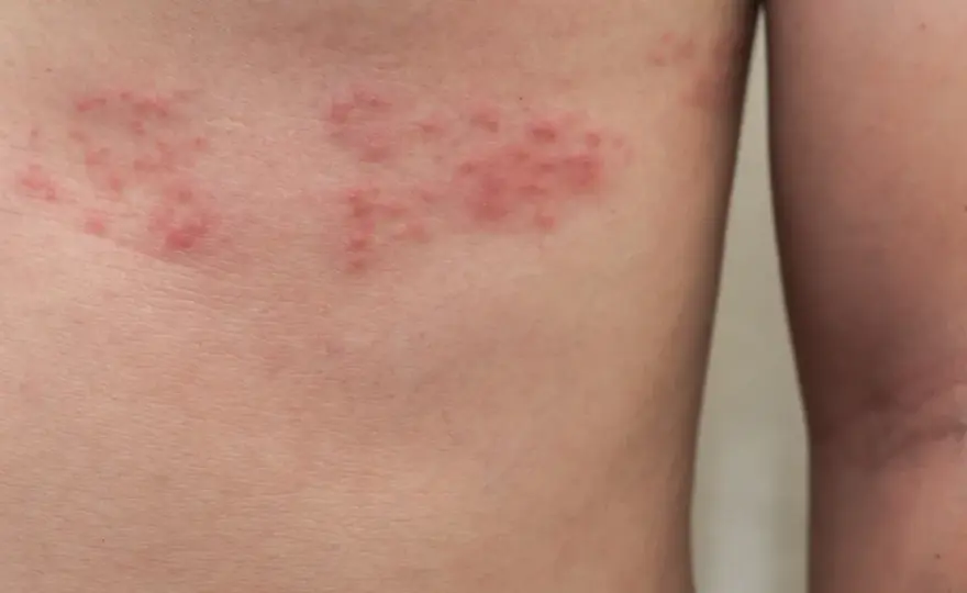 Czerwone plamy na ciele - Kiedy to alergia, a kiedy infekcja?