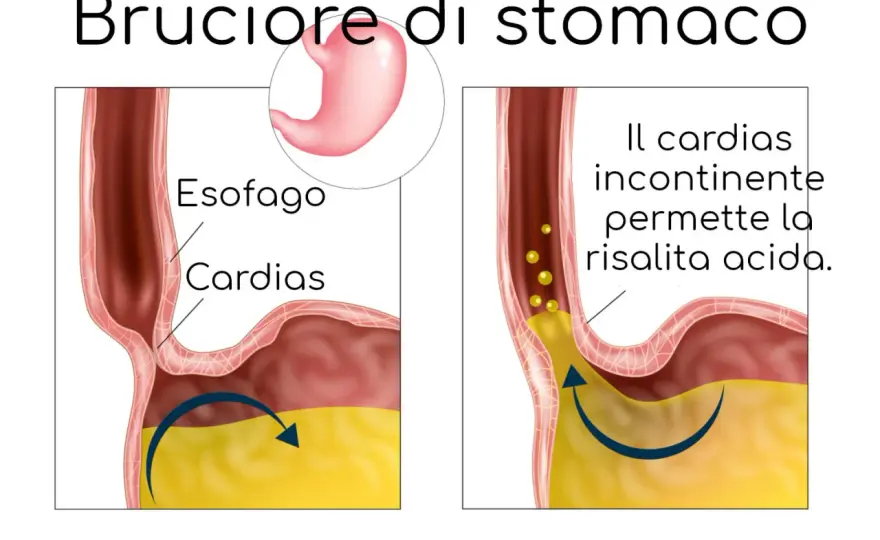 Fitta allo stomaco - cause e quando serve un medico