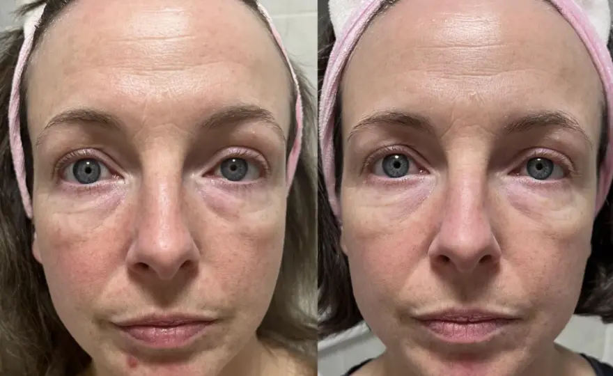 Niacinamide Vorher-Nachher - Was wirklich passiert & wann