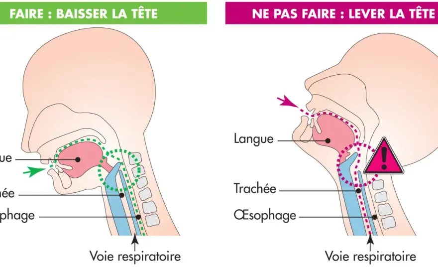 Difficulté à avaler - signes, causes et quand consulter