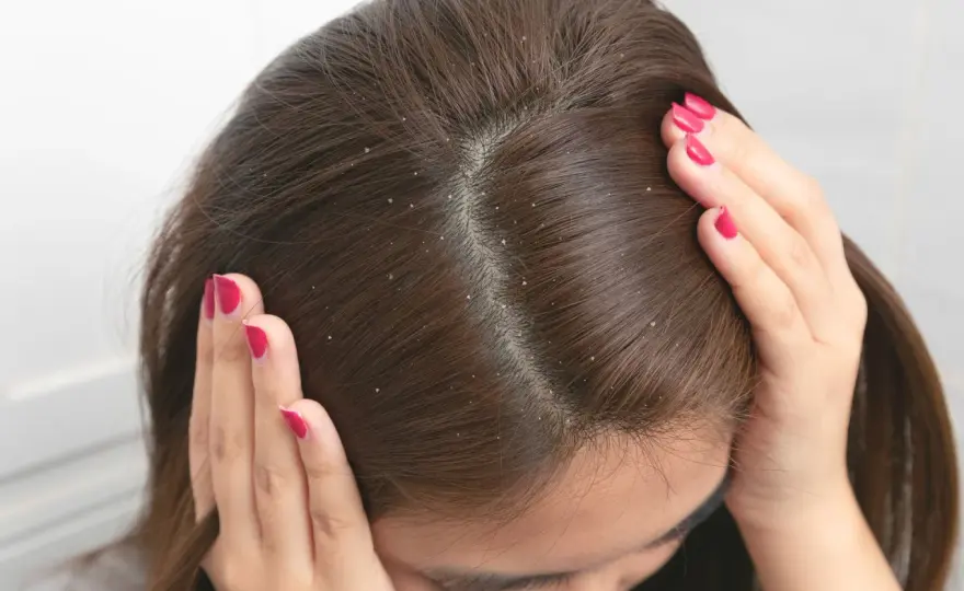 Jak pozbyć się łupieżu? Skuteczne sposoby i kiedy iść do dermatologa