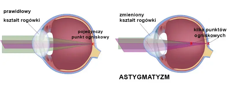 Czy wada wzroku to choroba? Poznaj prawdę o problemach ze wzrokiem