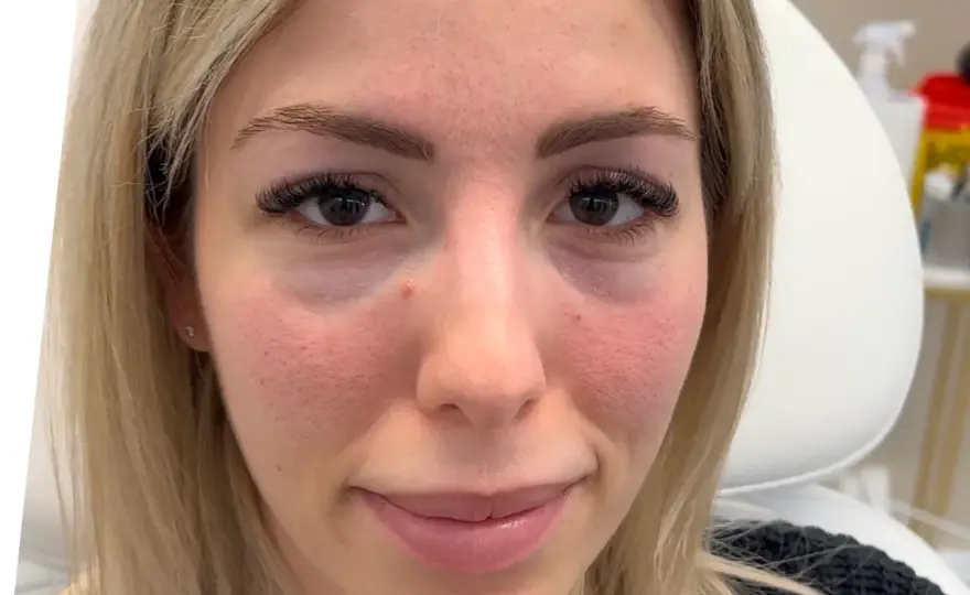 Tear trough filler - Få piggare ögon naturligt? Läs detta först!