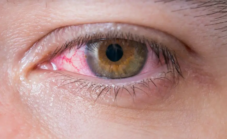 Ojo rojo en niños - ¿Cuándo preocuparse y qué hacer?