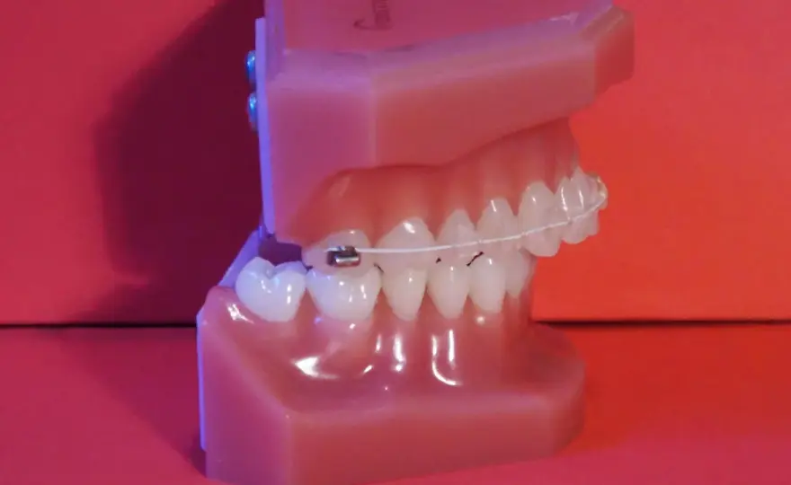 Dientes inclinados hacia afuera - causas y opciones de ortodoncia