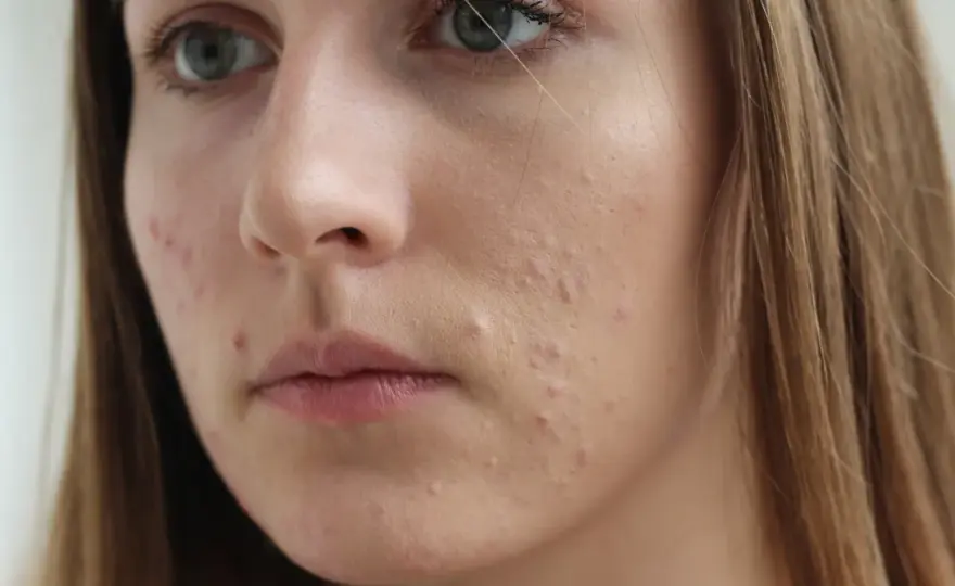 Sudocrem na pryszcze: Działa? Kiedy używać, by nie zaszkodzić?