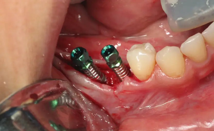 Dolore dopo impianto dentale - Quanto è normale e quando preoccuparsi?