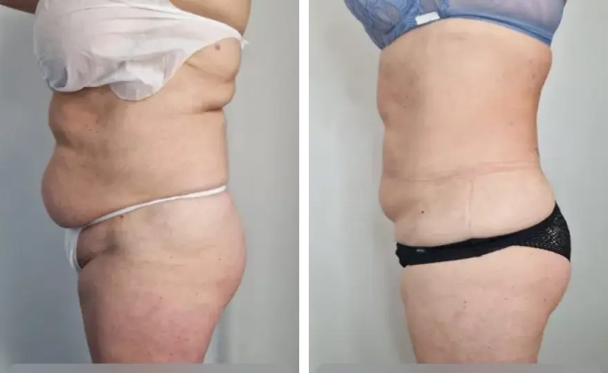 Liposukcja: Co to, metody, efekty i koszty? Pełny przewodnik!