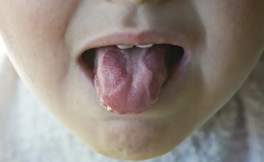 Stomatite nei bambini, come distinguere afte, herpes e mughetto