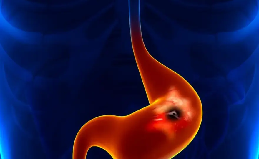 H. pylori a psychika - Czy bakteria wpływa na nastrój i lęk?