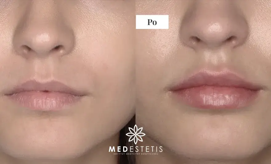 Kwas hialuronowy do ust: jak wybrać najlepszy dla naturalnego efektu?