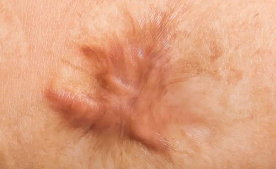 Cloque sur cicatrice - que faire sans l’aggraver ?