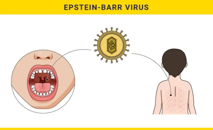 Wirus Epsteina-Barr - objawy i metody leczenia zakażenia