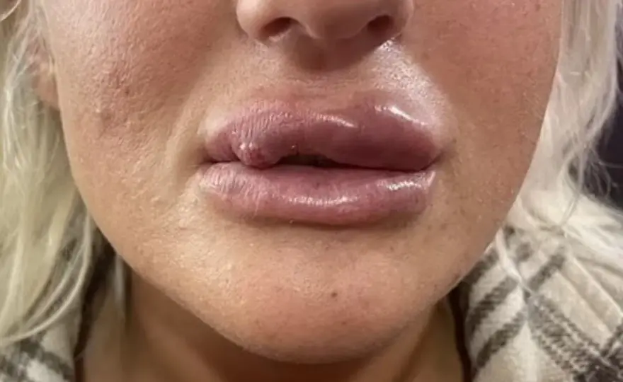 Flyga efter fillers? Så länge bör du vänta