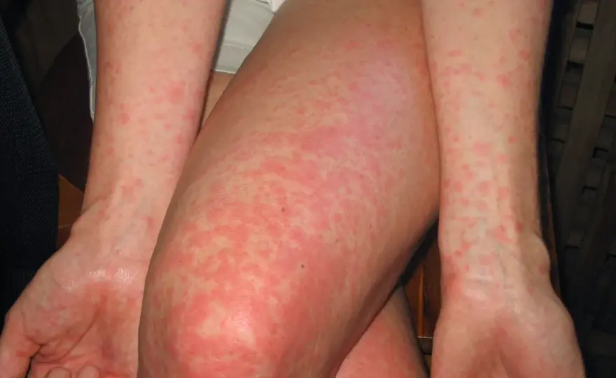 Alergia al pino - señales, pruebas y cómo aliviarla