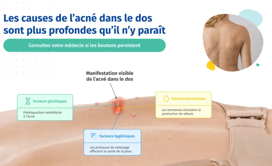Acné du dos chez l'adolescent - les bons gestes et quand consulter