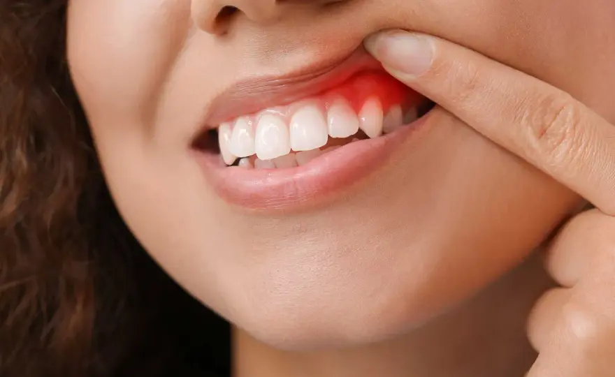 Ascesso dentale - sintomi, cure e quando è urgente