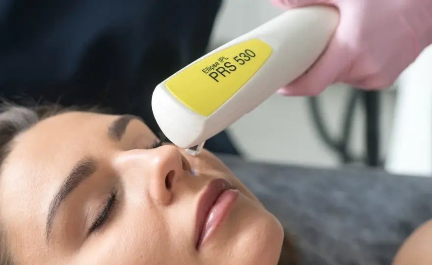 Naczynka na twarzy - laser, IPL czy elektrokoagulacja?