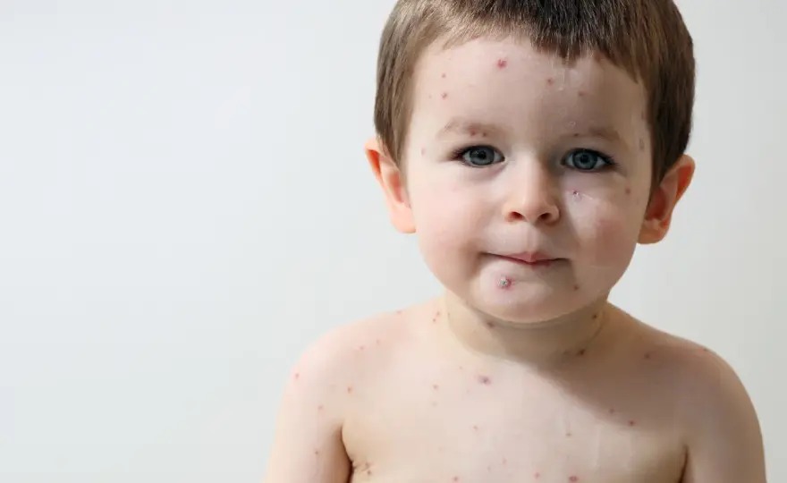 Febbre e macchie nei bambini - guida alle malattie esantematiche
