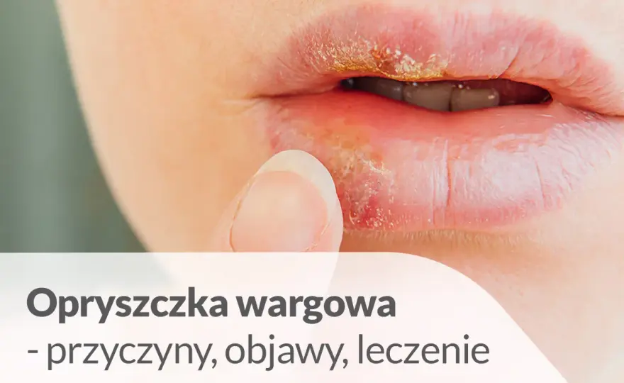 Zmiany na ustach - Opryszczka, zajady czy coś poważniejszego?