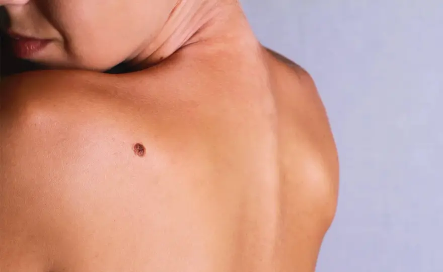 Grain de beauté en relief - quand consulter ?