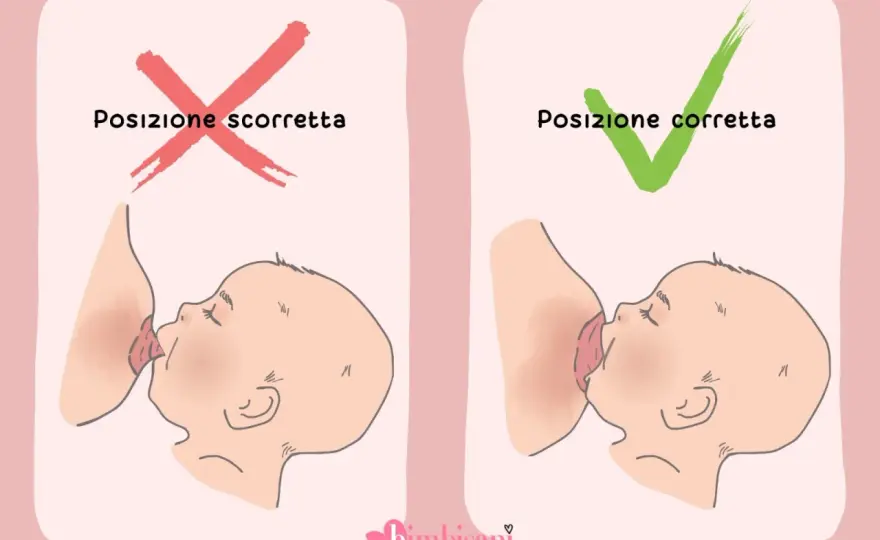 Ragadi al seno, come guarire e proteggere l’allattamento