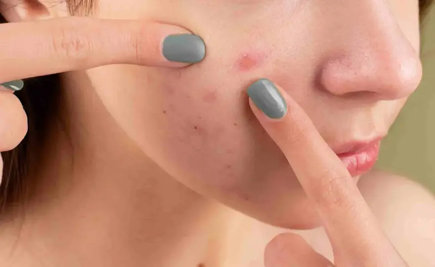 Dermatillomania - Come smettere di toccarsi la pelle?