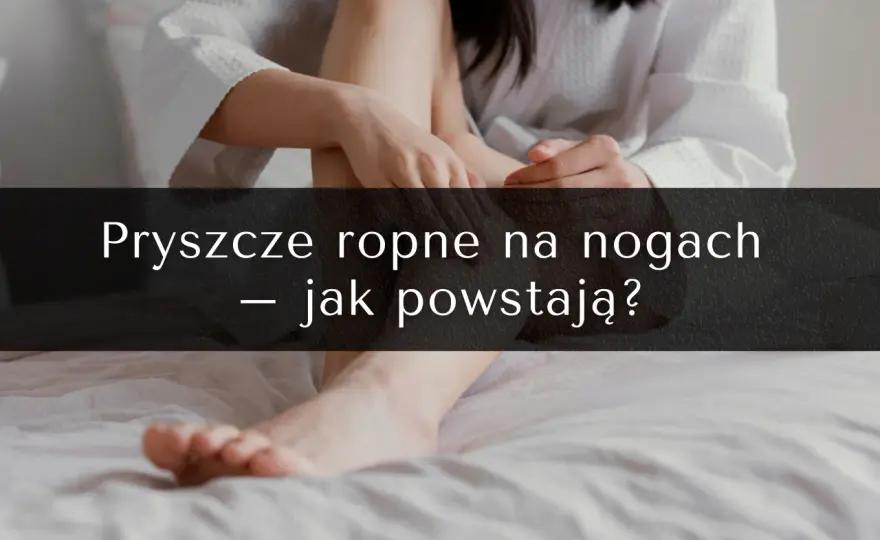 Pryszcze na nogach: przyczyny, skuteczne metody leczenia i profilaktyka