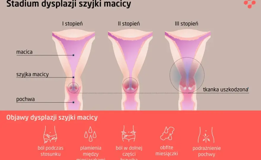 Dysplazja szyjki macicy - Czy to już rak? Sprawdź, co dalej!