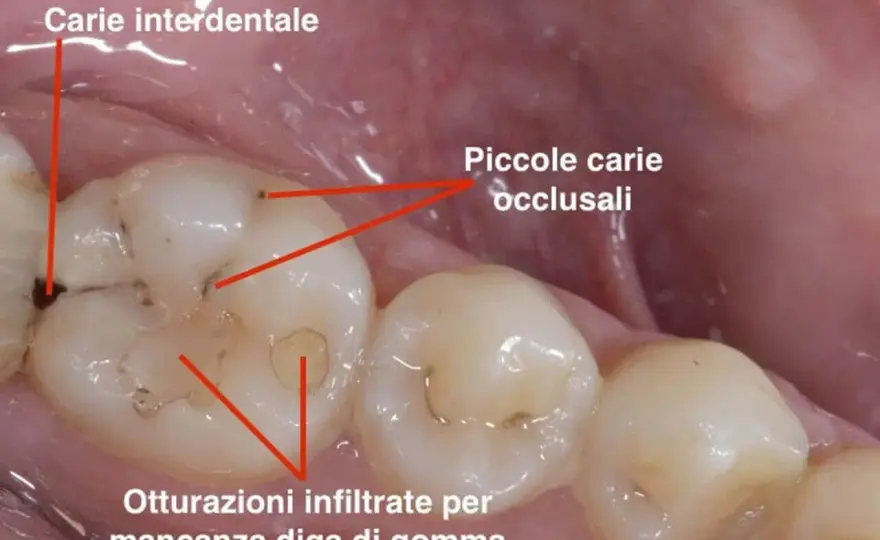 Odore tra i denti - è solo cibo o una carie?
