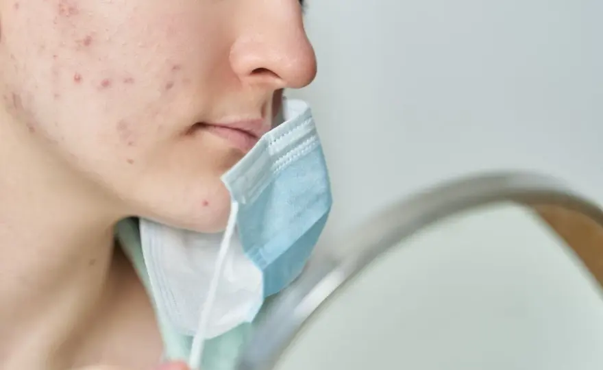 Acne da Mascherina - Soluzioni Efficaci per una Pelle Sana