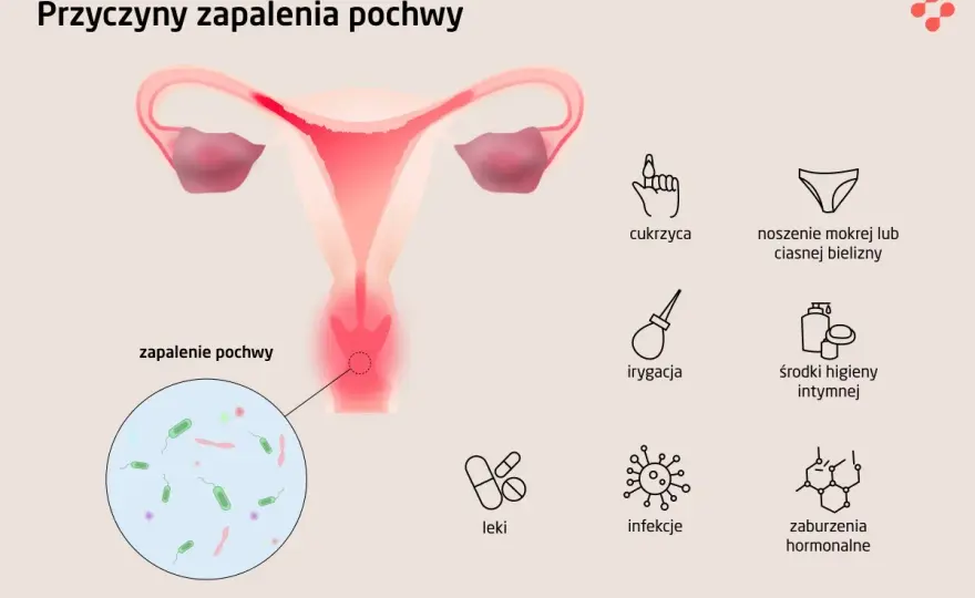 Zapalenie pochwy - objawy, przyczyny i skuteczne leczenie