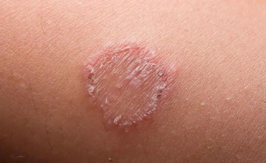 Micosi nei bambini - come riconoscere la tigna e cosa fare