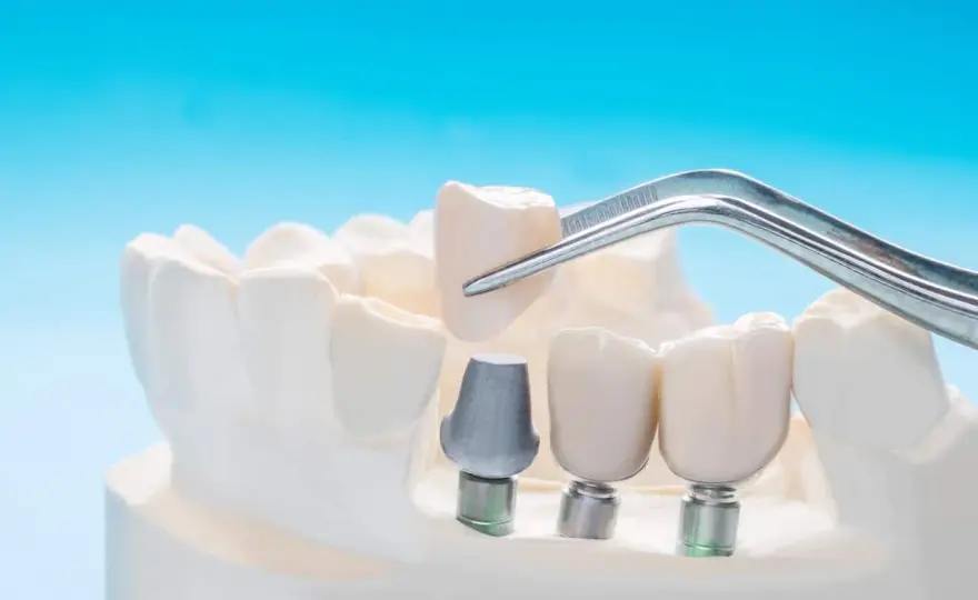Dente incapsulato - Quando conviene davvero? Guida completa