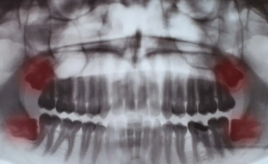 Kiedy rosną zęby mądrości? Objawy, ból i kiedy iść do dentysty