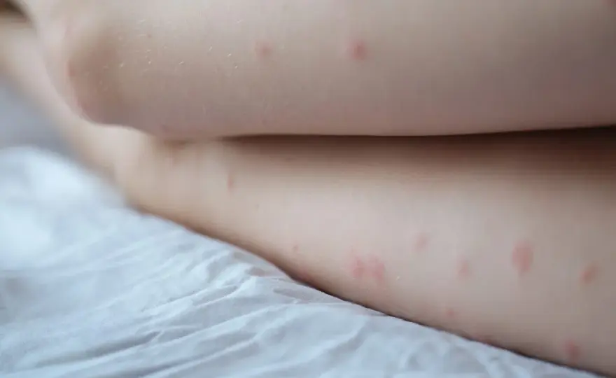 Krostki na pośladkach? To Folliculitis lub KP! Poznaj rozwiązania