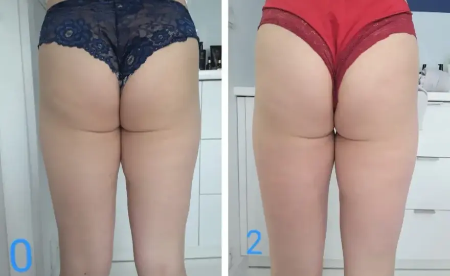 Endermologia - efekty, cena, po ilu zabiegach widać różnicę?