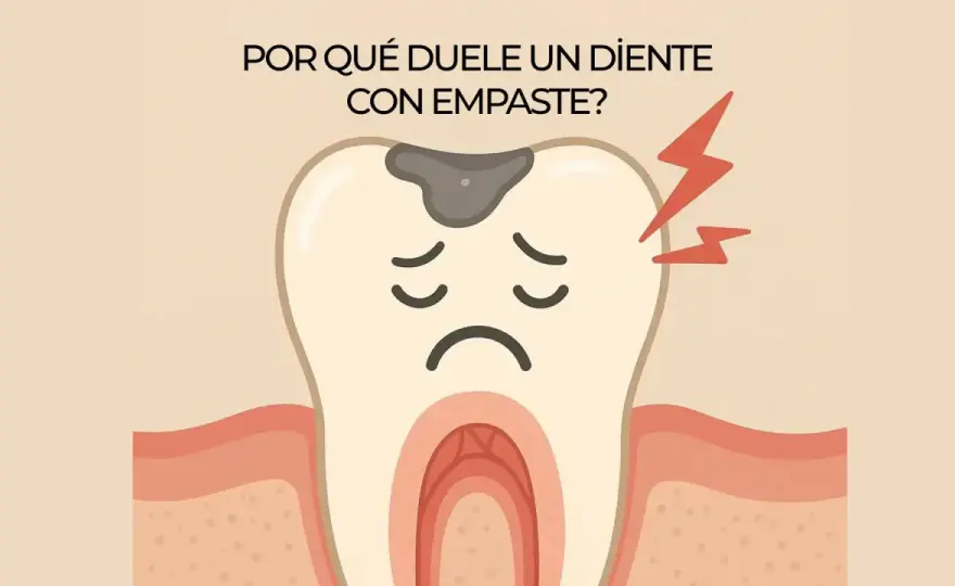 Muela empastada duele al morder ¿Cuándo preocuparse?