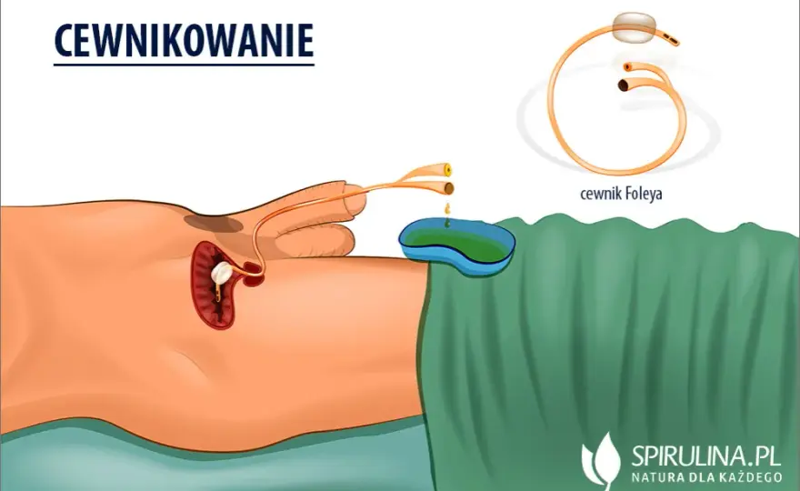 Po wyjęciu cewnika: objawy, zalecenia i kiedy iść do lekarza