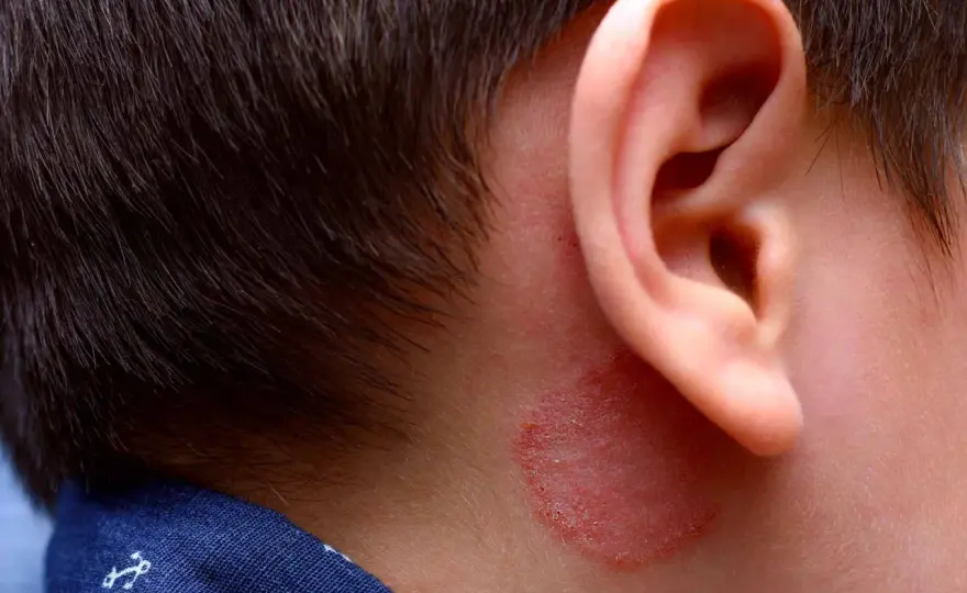 Micosi nei bambini, come riconoscere tigna e segnali d’allarme
