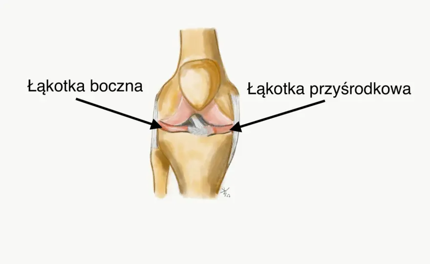 Łąkotka przyśrodkowa - co musisz wiedzieć o bólu kolana?