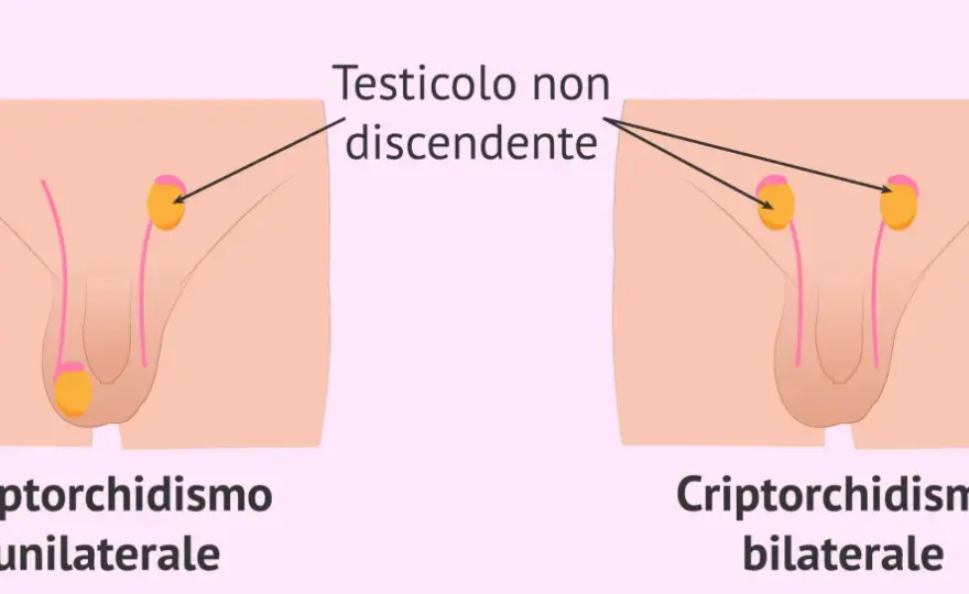 Testicolo non nello scroto a 10 anni - Cosa fare?